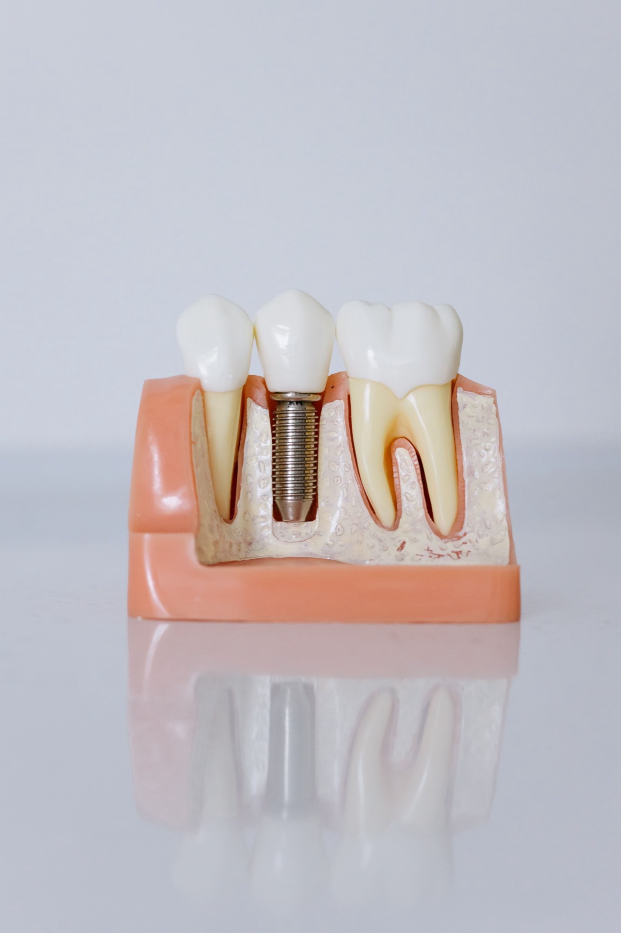 Implantes Dentários — FCA Odontologia