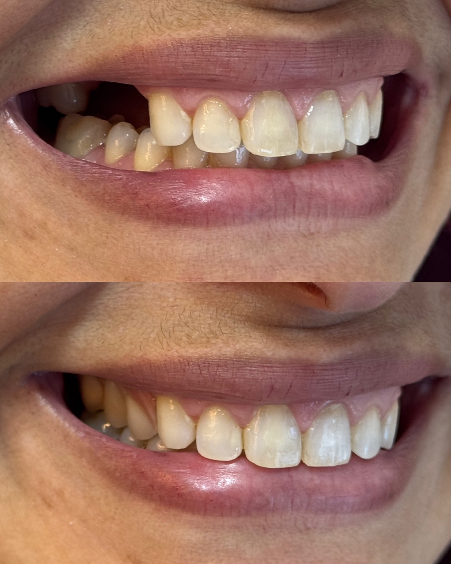 Resultado Prótese Dental — FCA Odontologia