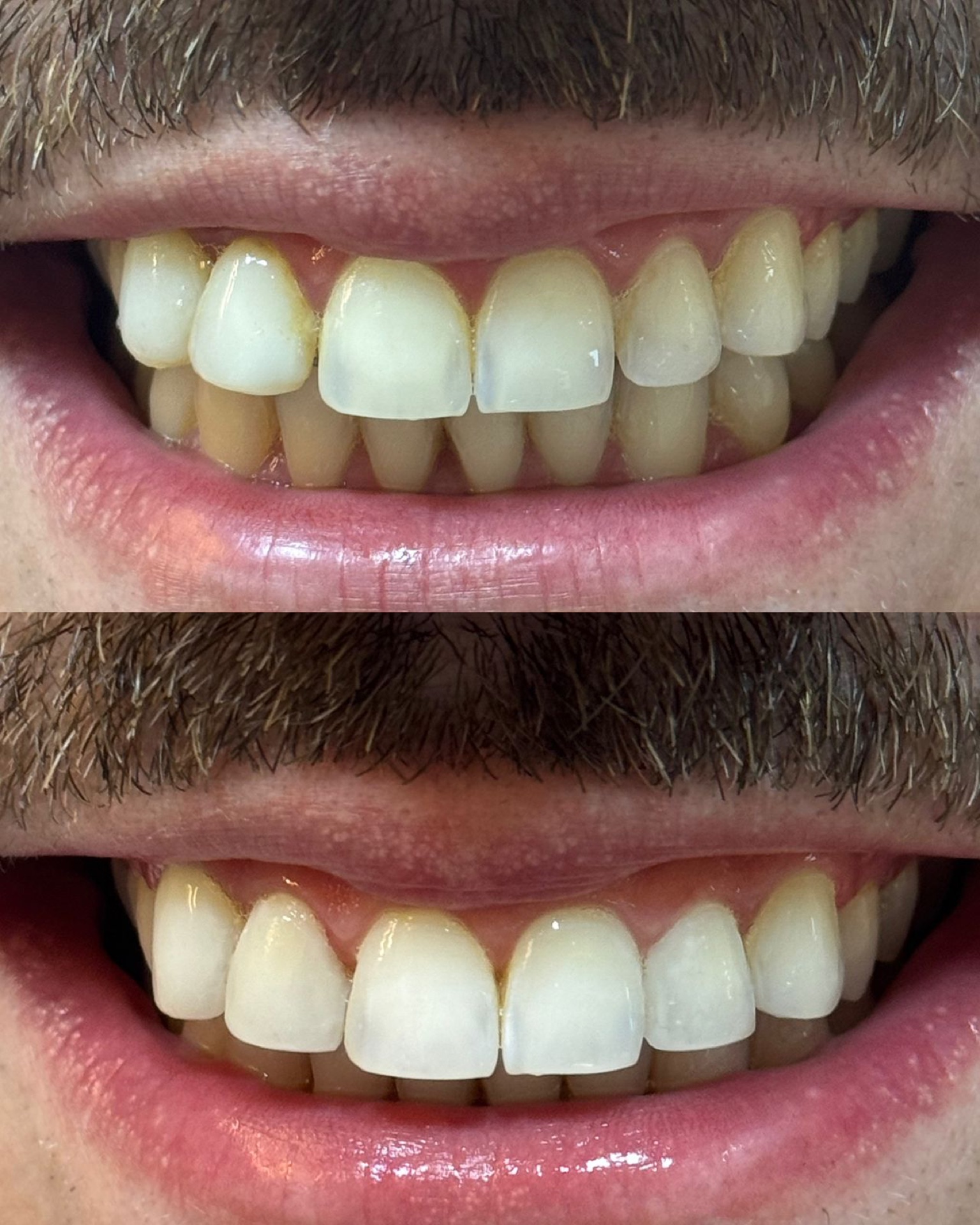 Resultado Clareamento Dental — FCA Odontologia