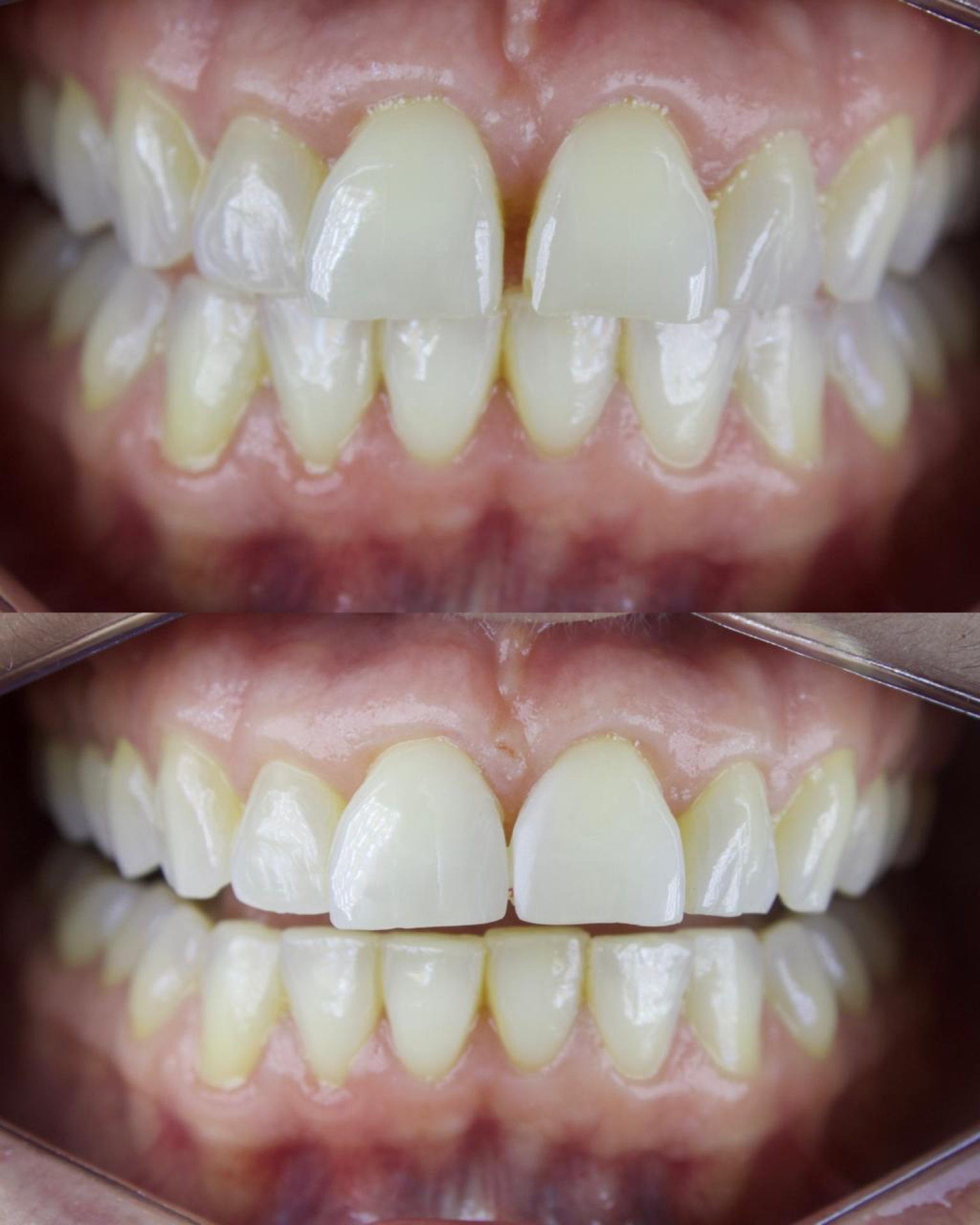 Resultado Fechamento de Diastema — FCA Odontologia